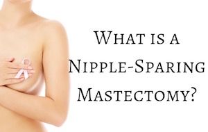 What is a nipple sparing mastectomy