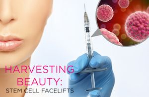 Facelifts using stem cells