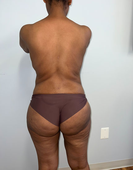 Mommy Makeover