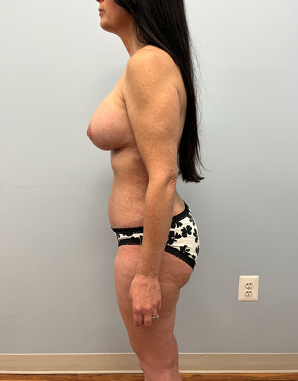Mommy Makeover