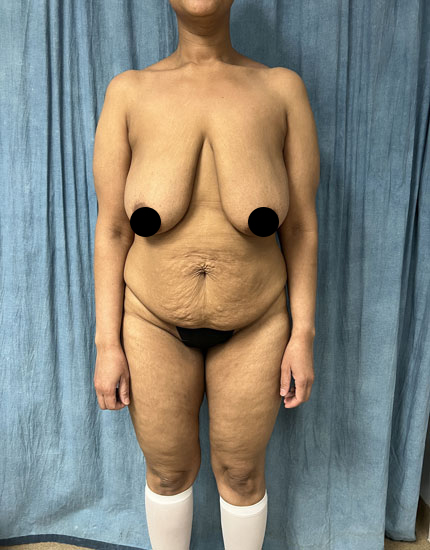 Mommy Makeover Before & After Image