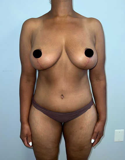 Mommy Makeover Before & After Image