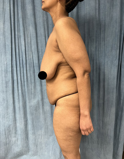 Mommy Makeover Before & After Image