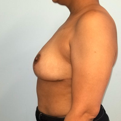 Breast Reduction Before & After Image