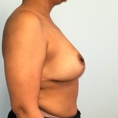 Breast Reduction Before & After Image