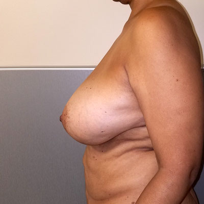 Breast Reduction Before & After Image
