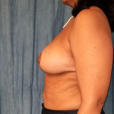 Breast Reduction Before & After Image