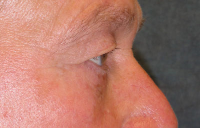 Eyelid Surgery Before & After Image