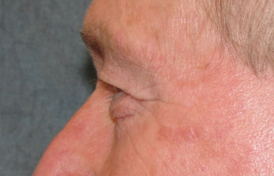 Eyelid Surgery Before & After Image